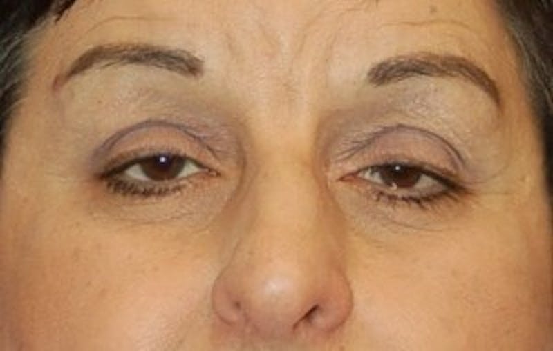 Eyelid Surgery Before & After Gallery - Patient 89991006 - Image 1