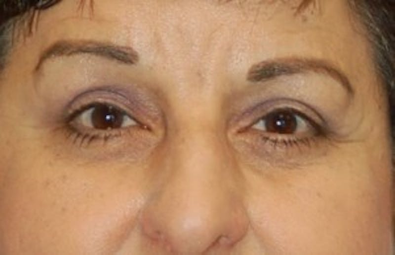 Eyelid Surgery Before & After Gallery - Patient 89991006 - Image 2