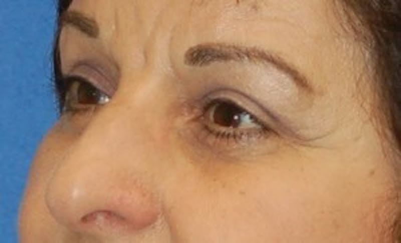 Eyelid Surgery Before & After Gallery - Patient 89991006 - Image 4