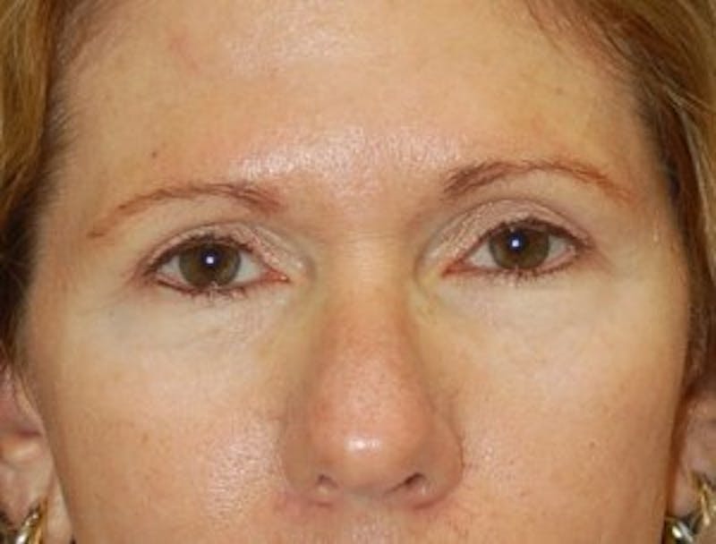 Eyelid Surgery Before & After Gallery - Patient 89991019 - Image 2