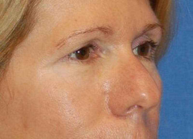 Eyelid Surgery Before & After Gallery - Patient 89991019 - Image 3