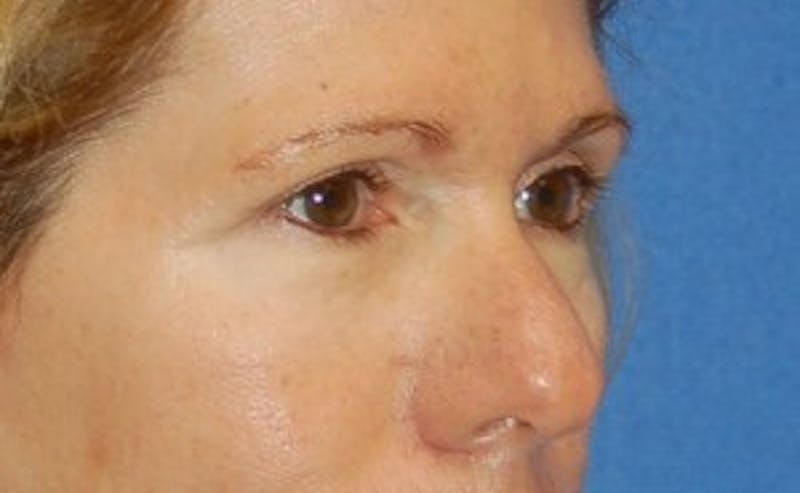 Eyelid Surgery Before & After Gallery - Patient 89991019 - Image 4