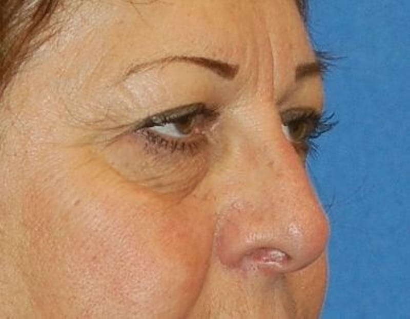 Eyelid Surgery Before & After Gallery - Patient 89991035 - Image 3