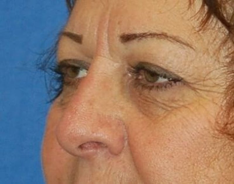 Eyelid Surgery Before & After Gallery - Patient 89991035 - Image 5
