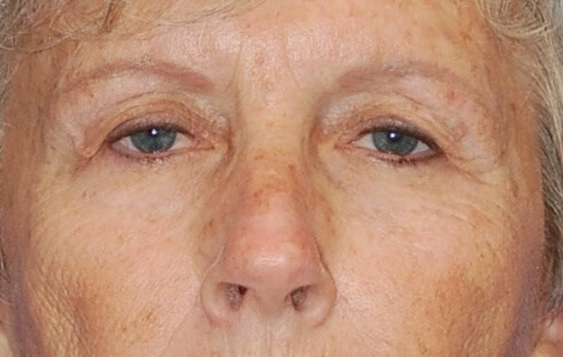 Eyelid Surgery Before & After Gallery - Patient 89991048 - Image 1