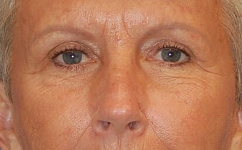 Eyelid Surgery Before & After Gallery - Patient 89991048 - Image 2