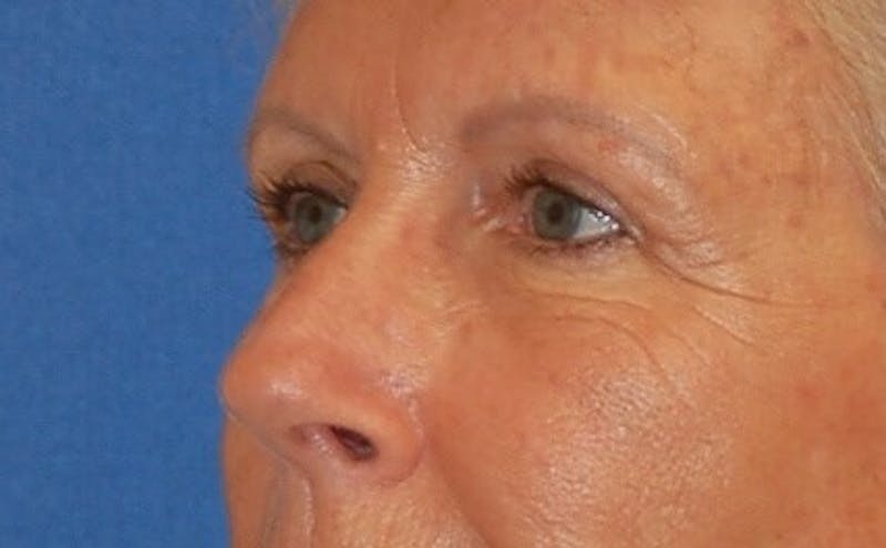 Eyelid Surgery Before & After Gallery - Patient 89991048 - Image 4