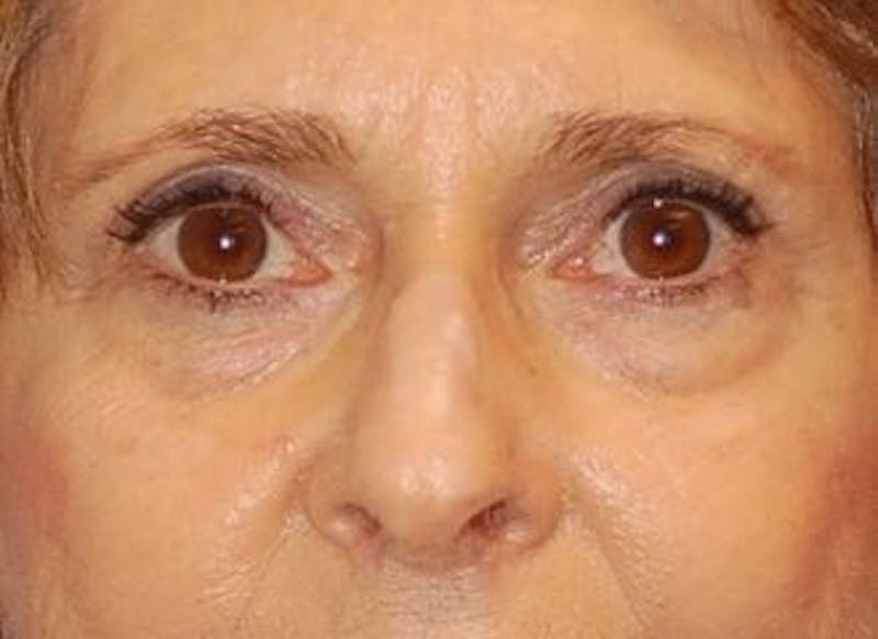 Eyelid Surgery Before & After Gallery - Patient 89991064 - Image 1