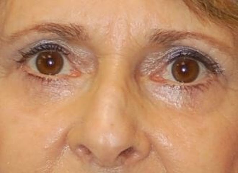 Eyelid Surgery Before & After Gallery - Patient 89991064 - Image 2