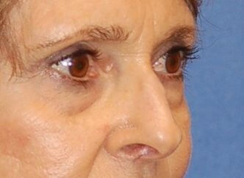 Eyelid Surgery Before & After Gallery - Patient 89991064 - Image 3