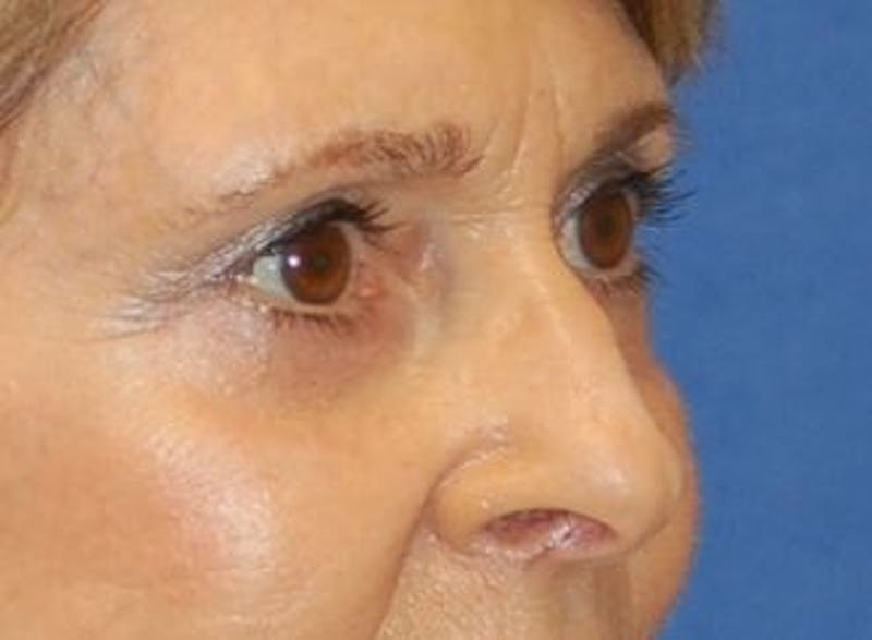 Eyelid Surgery Before & After Gallery - Patient 89991064 - Image 4