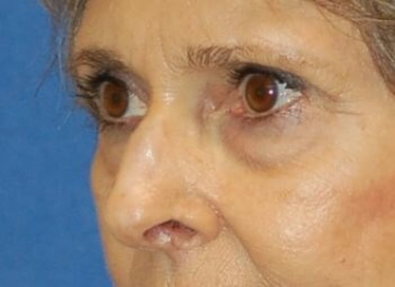 Eyelid Surgery Before & After Gallery - Patient 89991064 - Image 5