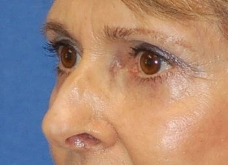 Eyelid Surgery Before & After Gallery - Patient 89991064 - Image 6