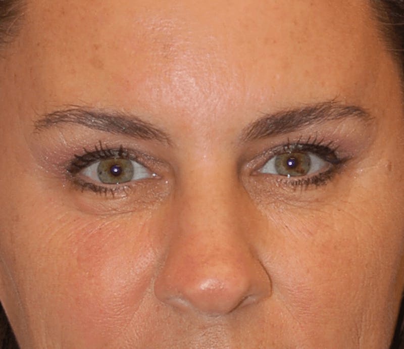 Eyelid Surgery Before & After Gallery - Patient 89991089 - Image 1
