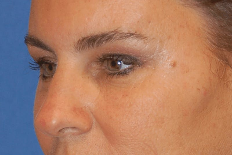 Eyelid Surgery Before & After Gallery - Patient 89991089 - Image 3