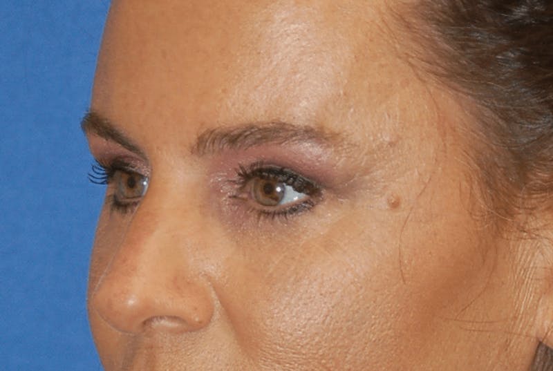 Eyelid Surgery Before & After Gallery - Patient 89991089 - Image 4