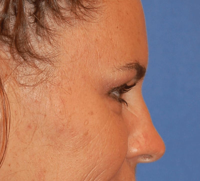 Eyelid Surgery Before & After Gallery - Patient 89991089 - Image 5