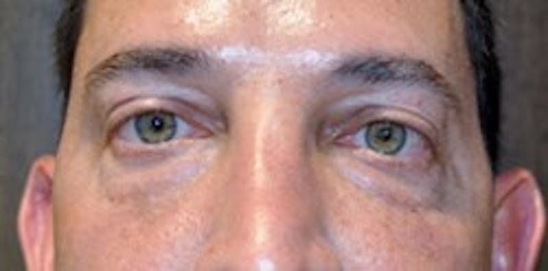 Eyelid Surgery Before & After Gallery - Patient 89991384 - Image 1