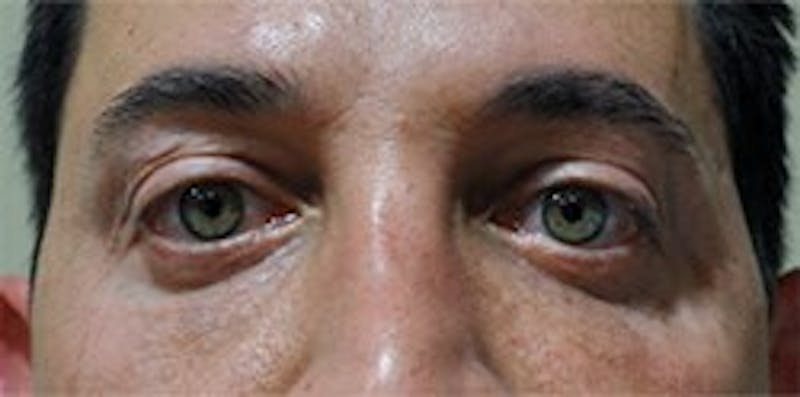 Eyelid Surgery Before & After Gallery - Patient 89991384 - Image 2