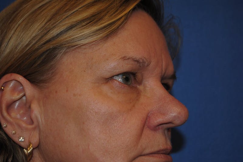 Eyelid Surgery Before & After Gallery - Patient 89991416 - Image 3