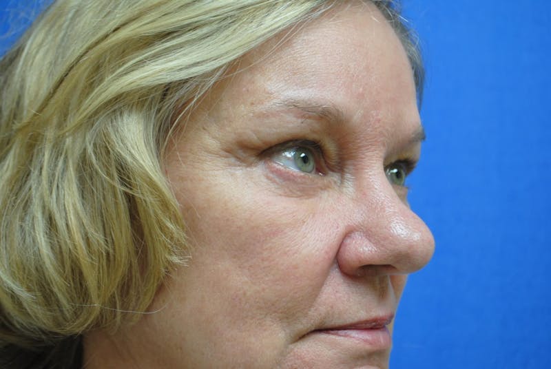 Eyelid Surgery Before & After Gallery - Patient 89991416 - Image 4