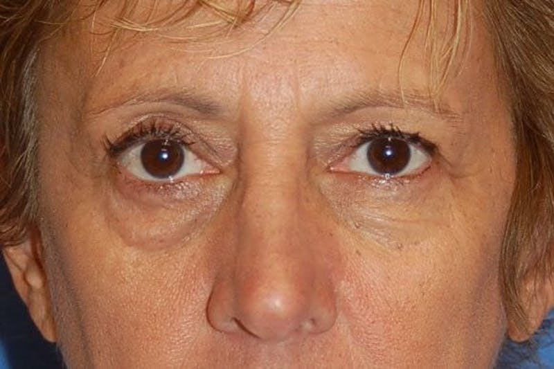 Eyelid Surgery Before & After Gallery - Patient 89991432 - Image 1