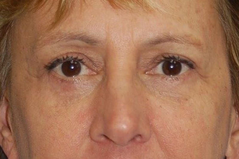 Eyelid Surgery Before & After Gallery - Patient 89991432 - Image 2