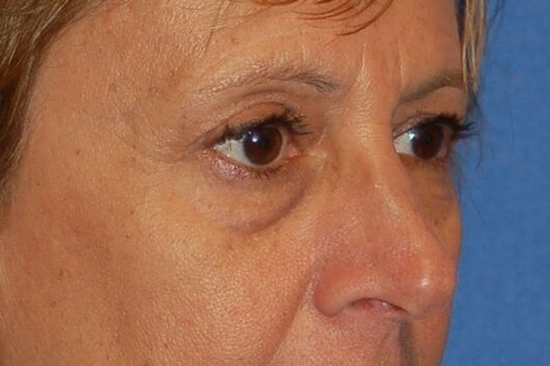 Eyelid Surgery Before & After Gallery - Patient 89991432 - Image 3