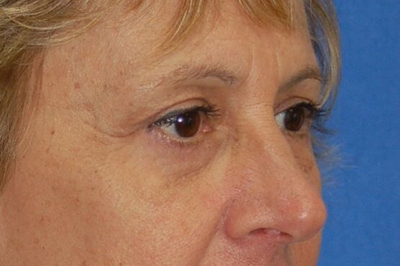 Eyelid Surgery Before & After Gallery - Patient 89991432 - Image 4
