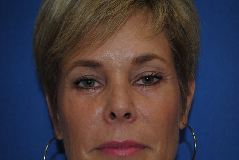 Eyelid Surgery Before & After Gallery - Patient 89991451 - Image 2
