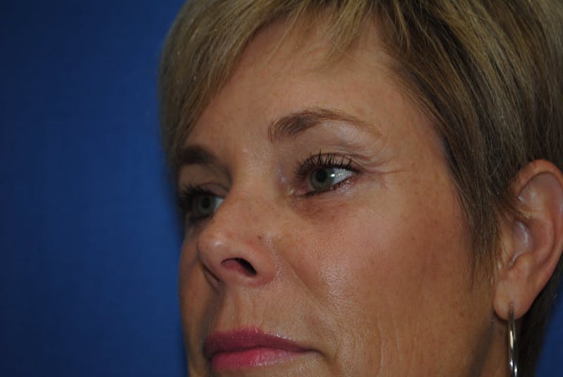 Eyelid Surgery Before & After Gallery - Patient 89991451 - Image 4