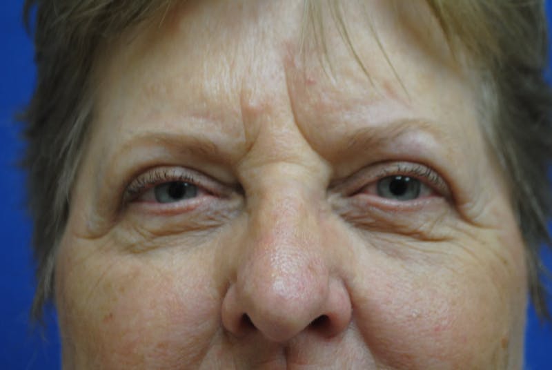 Eyelid Surgery Before & After Gallery - Patient 89991472 - Image 1