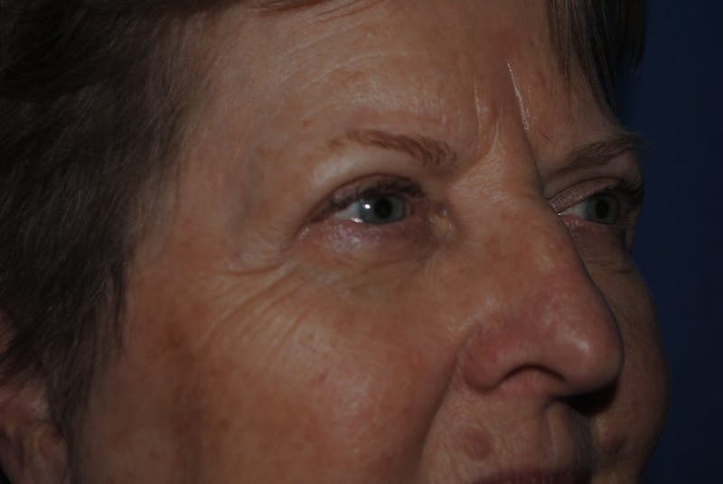 Eyelid Surgery Before & After Gallery - Patient 89991472 - Image 4