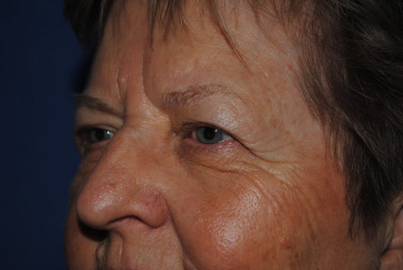 Eyelid Surgery Gallery - Patient 89991472 - Image 5