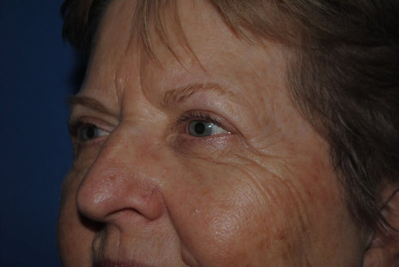 Eyelid Surgery Before & After Gallery - Patient 89991472 - Image 6