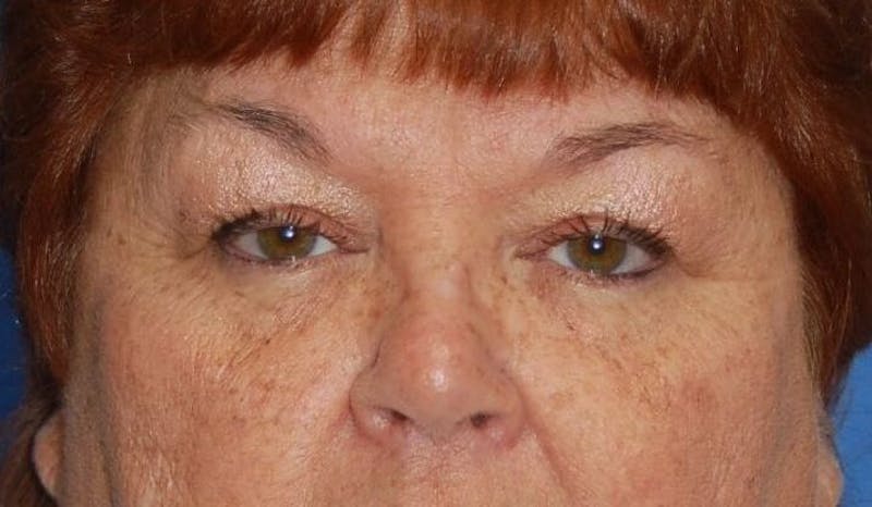 Eyelid Surgery Before & After Gallery - Patient 89991485 - Image 1
