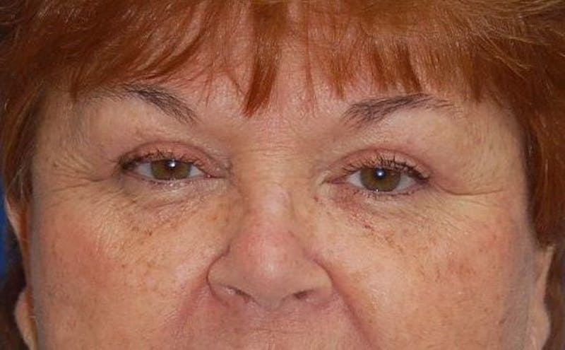 Eyelid Surgery Before & After Gallery - Patient 89991485 - Image 2