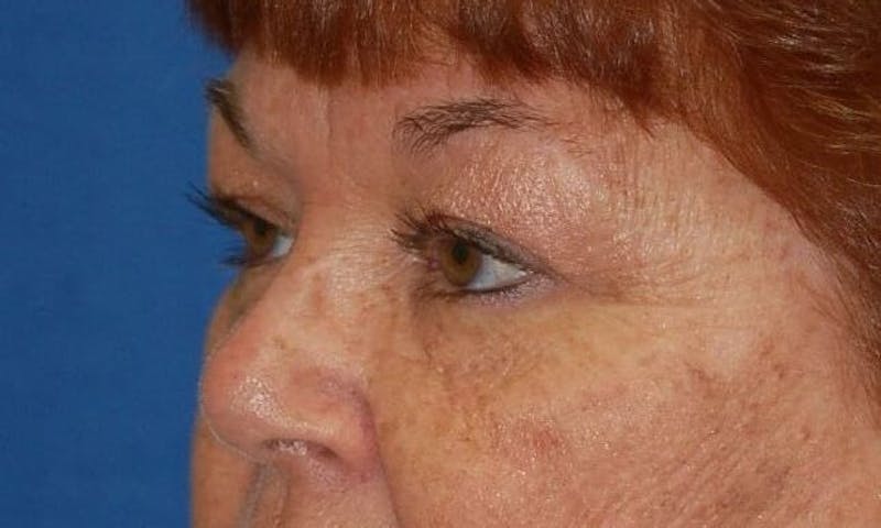 Eyelid Surgery Before & After Gallery - Patient 89991485 - Image 3