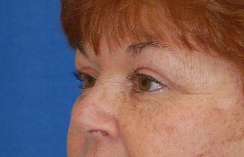 Eyelid Surgery Before & After Gallery - Patient 89991485 - Image 4
