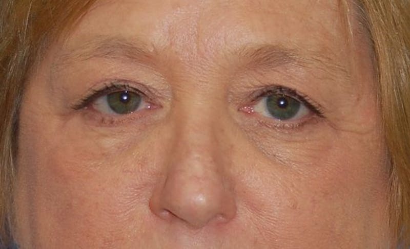 Eyelid Surgery Before & After Gallery - Patient 89996295 - Image 1