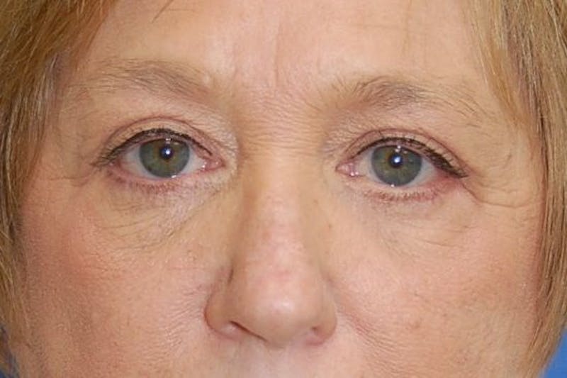 Eyelid Surgery Before & After Gallery - Patient 89996295 - Image 2