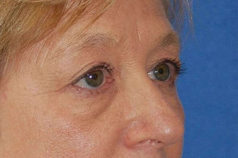 Eyelid Surgery Before & After Gallery - Patient 89996295 - Image 3