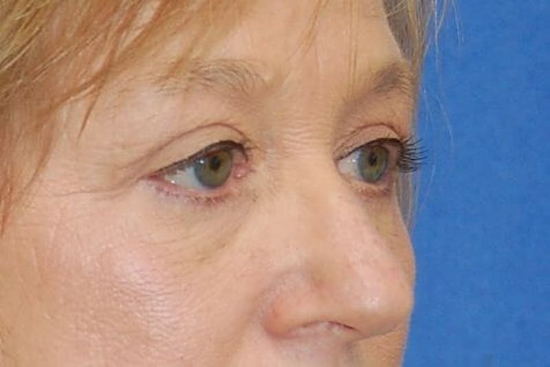 Eyelid Surgery Before & After Gallery - Patient 89996295 - Image 4