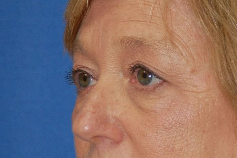 Eyelid Surgery Before & After Gallery - Patient 89996295 - Image 5