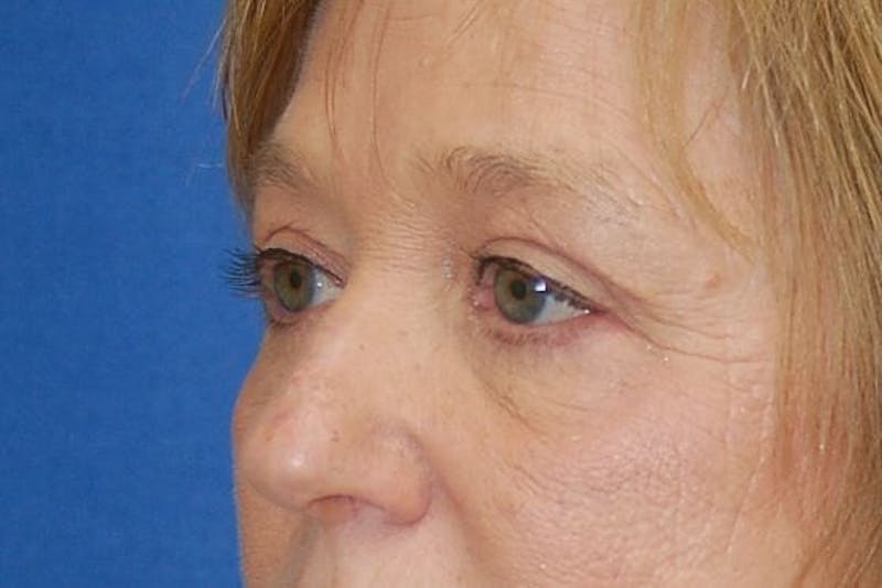 Eyelid Surgery Before & After Gallery - Patient 89996295 - Image 6