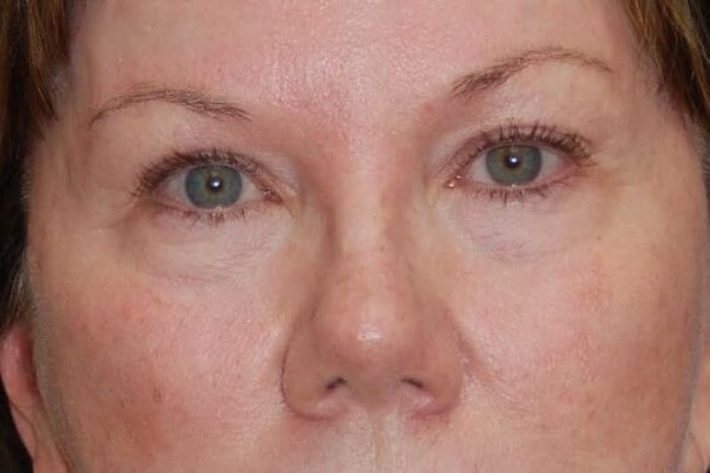 Eyelid Surgery Before & After Gallery - Patient 90005916 - Image 1