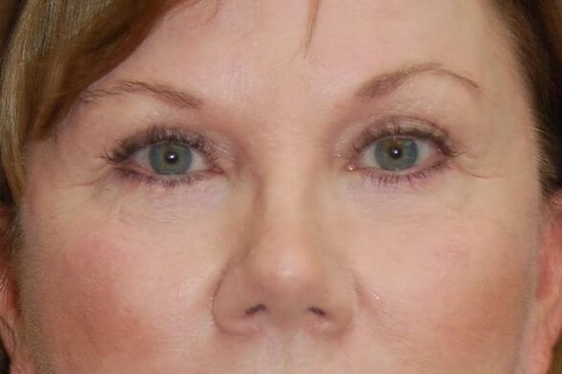 Eyelid Surgery Before & After Gallery - Patient 90005916 - Image 2