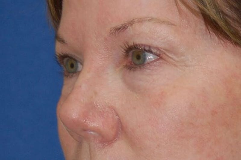 Eyelid Surgery Before & After Gallery - Patient 90005916 - Image 3