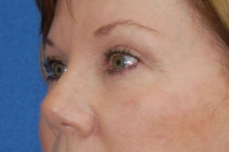 Eyelid Surgery Before & After Gallery - Patient 90005916 - Image 4