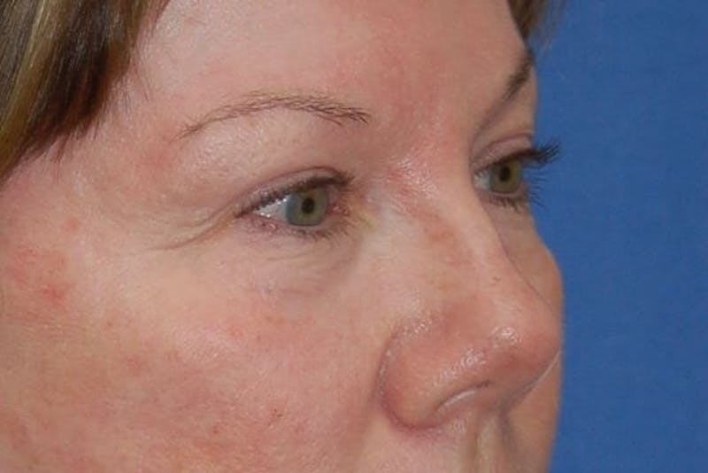 Eyelid Surgery Before & After Gallery - Patient 90005916 - Image 5